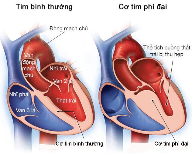 Cơ tim phì đại - Hình ảnh minh họa